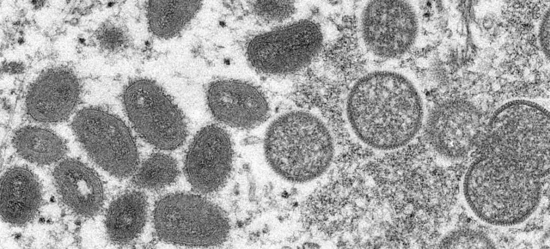猴痘是一种罕见但危险的传染病，类似于现已根除的天花病毒。图源：美国疾病控制和预防中心