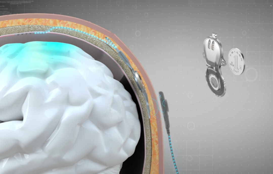 图丨无线微创植入脑机接口 NEO 系统及其体内系统（来源：清华大学官网）