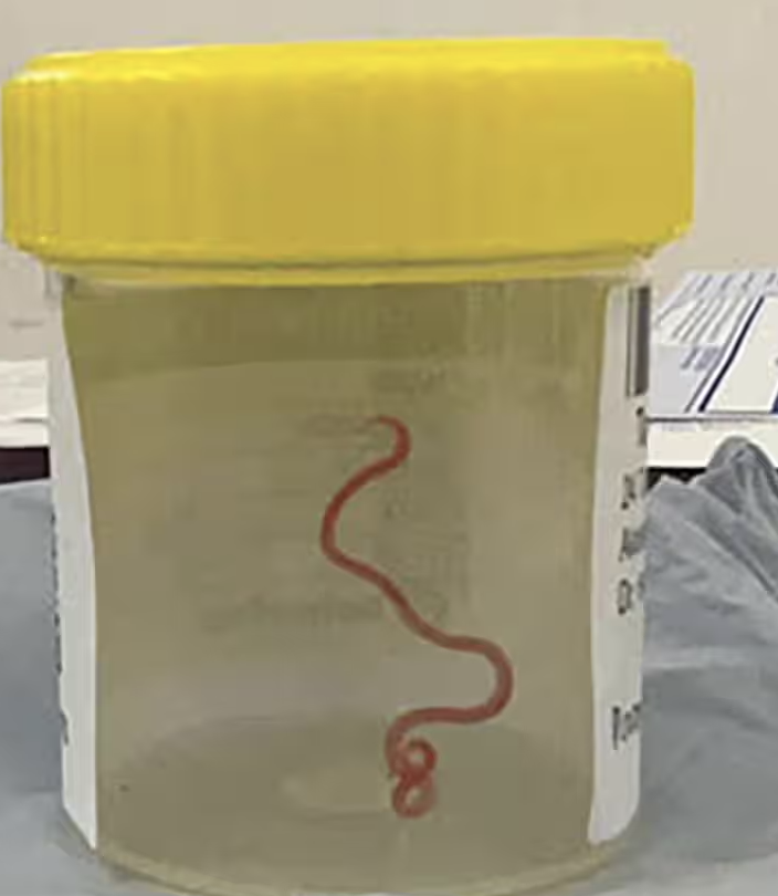 还在蠕动！全球首例蛇蛔虫感染：脑中取出8厘米活体蛔虫，本应寄生于蟒蛇消化系统