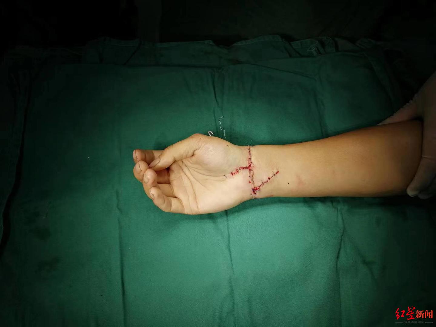 右手保住了！29岁小伙右手被齐腕“切断”，医生通宵缝合肌腱、神经、血管