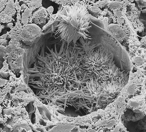 人类肝脏脂滴胆固醇结晶扫描电子显微镜图像。图片来源：Steve Gschmeissne